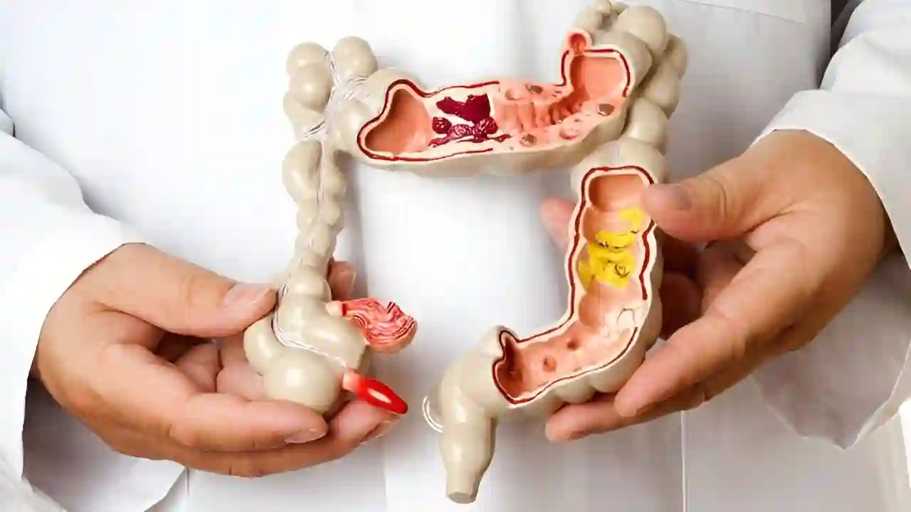 Irritable Bowel Syndrome